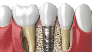 Digital illustration of a single dental implant in The Colony