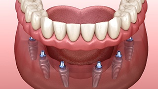 Digital illustration of dental implant dentures in The Colony
