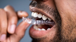 A man requiring adult orthodontics in The Colony and using MTM clear aligners to achieve a healthier, more aesthetically pleasing smile