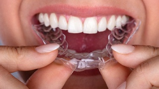 A person inserting a clear aligner into the top arch of their teeth