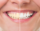 Person's teeth before and after whitening