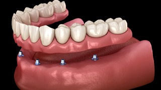 implant retained denture with snaps