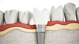 single dental implant embedded in jaw