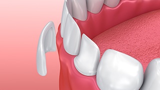 The Colony Cosmetic Dentist animation of porcelain veneer