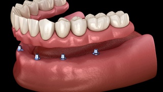 implant retained denture porcelain teeth