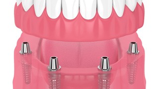 illustration of implant dentures for cost of dentures in The Colony  
    