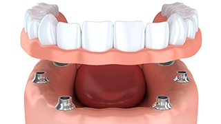 implant dentures