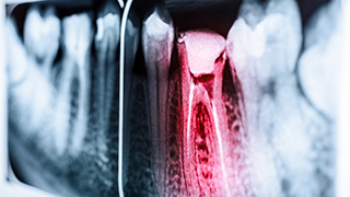 X-ray of a dental emergency in The Colony 