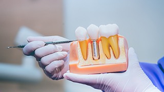 Dentist pointing to dental implant model