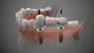 Digital illustration of dental implant bridge in The Colony