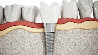 dental implant illustration