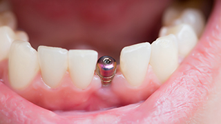 close-up of a person smiling with a dental implant 