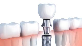 model of how dental implants in The Colony work
