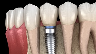 dental implant in the lower jaw 