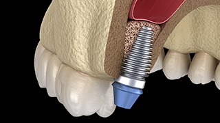 dental implant in the upper jaw 