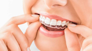 woman putting on clear aligner