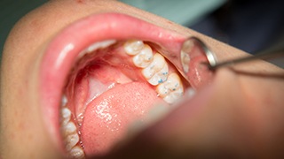 teeth examined with dental mirror