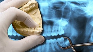 Model and x-ray of wisdom teeth