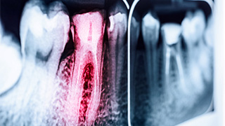root canal X-Ray