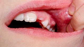 Close up of a bump on a patient’s gums