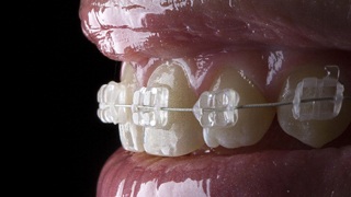 close-up view of a person’s mouth while undergoing Six Month Smiles in The Colony