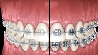 a computer illustration showing the difference between metal and tooth-colored braces