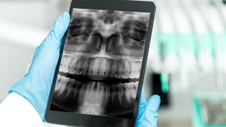 dentist holding tablet showing x-ray of teeth