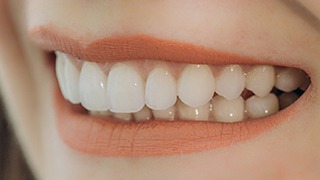 Closeup of woman smiling with dental veneers in The Colony