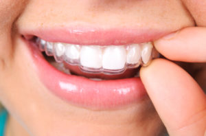 woman smiling Invisalign aligners 