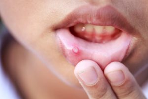 a person showing the canker sore in their mouth