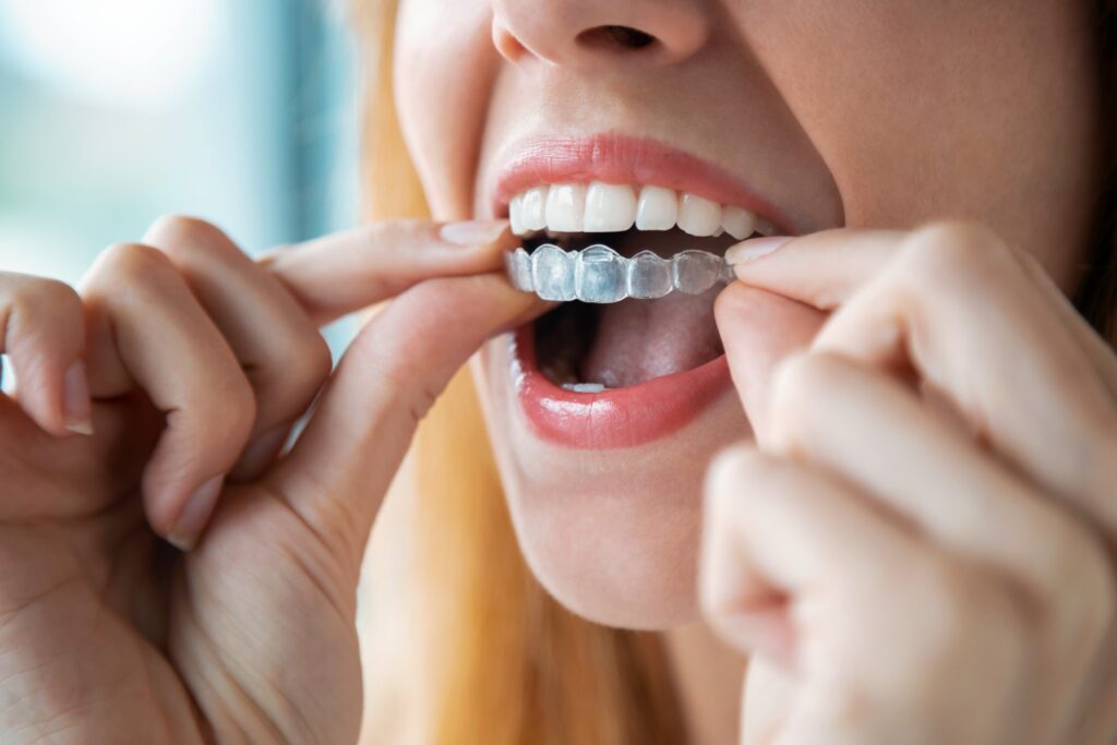 Woman placing clear aligner on top teeth